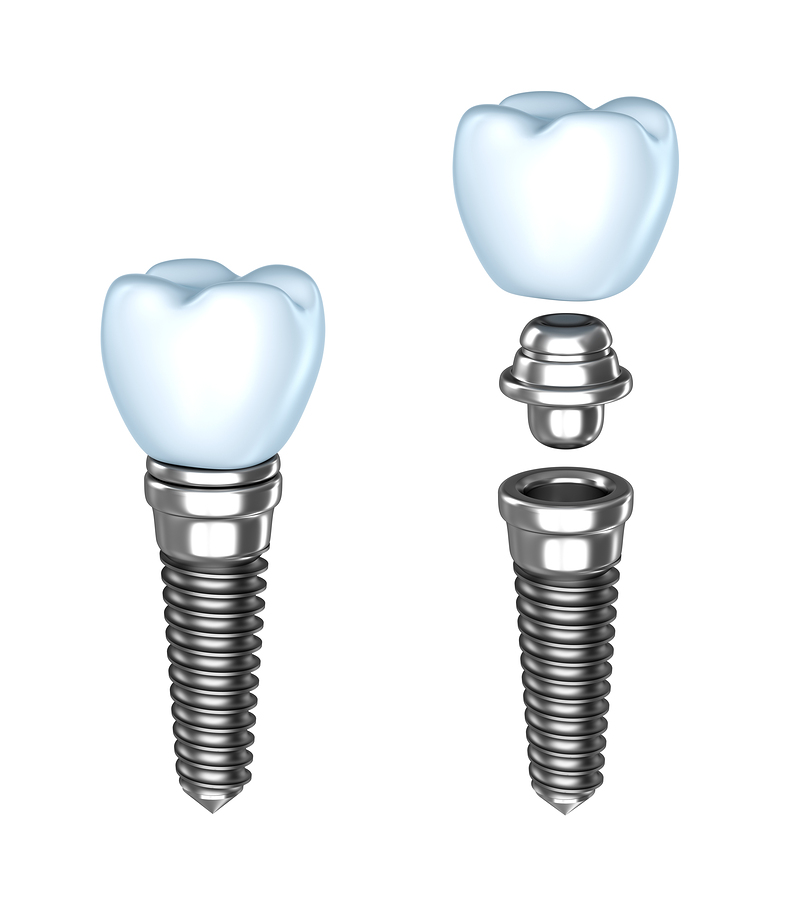 Dental Implants Upland CA
